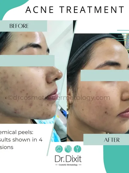 This transformation was achieved with a series of four carefully selected chemical peels. Peels are an excellent way to manage active acne and reduce post-inflammatory hyperpigmentation by exfoliating the skin and unclogging pores, revealing a brighter, more even complexion.