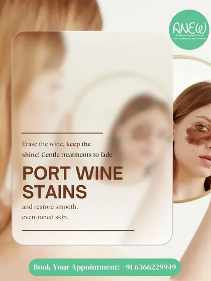 Erase the wine, keep the shine. We use gentle, advanced laser treatments to effectively fade Port Wine Stains, helping to restore a smooth, even-toned, and confident complexion.