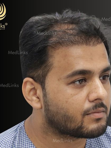 A side profile view before the procedure, showing the receding hairline and thinning at the temples. This angle is crucial for planning a hairline that frames the face naturally.