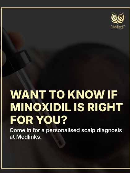 Minoxidil is a popular treatment, but is it right for you? The best way to know for sure is to come in for a personalized scalp diagnosis where we can assess your specific condition and advise accordingly.