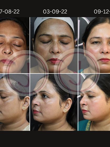 This series documents a five-month journey to combat severe hyperpigmentation. Using a carefully planned course of depigmenting peels, you can see the progressive lightening of dark patches and the emergence of a more even, radiant complexion over time.