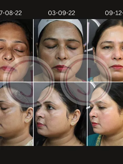 This series documents a five-month journey to combat severe hyperpigmentation. Using a carefully planned course of depigmenting peels, you can see the progressive lightening of dark patches and the emergence of a more even, radiant complexion over time.