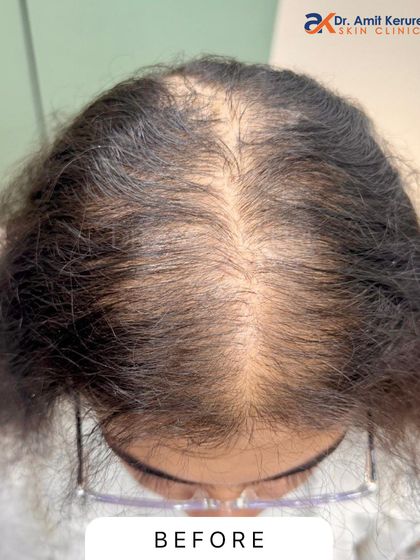 This is the 'before' photo of a patient experiencing significant thinning at the crown and a wide partition. This is a typical presentation of female pattern hair loss that I frequently treat at my clinic.