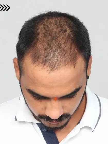 A complete 10-month transformation for a Diffuse Grade 5A case. We recreated the hairline and added density to the frontal and mid-scalp with 3,800 grafts.