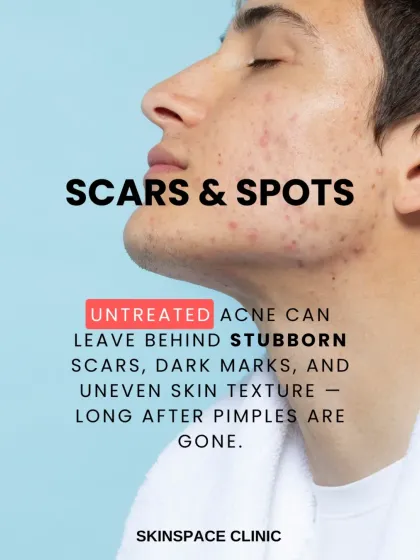 Untreated or poorly managed acne can leave behind stubborn scars and dark marks long after the pimples are gone. Our goal is to treat active acne effectively to prevent this long-term damage.