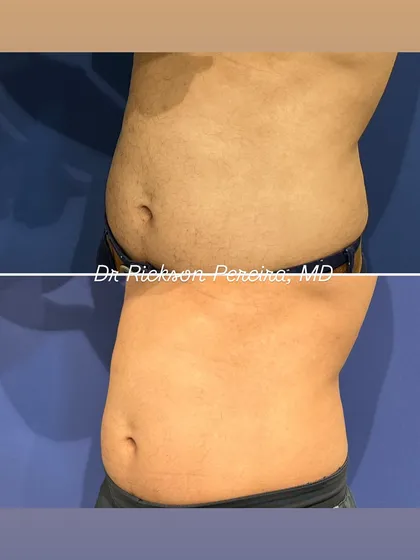 Another angle demonstrating the successful fat loss in the abdominal area. Notice the improved contour and flatter profile. This is not just weight loss; it is a strategic reduction of fat for a healthier, stronger physique.