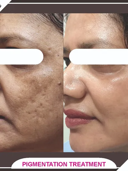 A side profile view of our pigmentation treatment results, showing a dramatic improvement in skin clarity and tone.