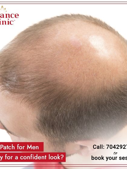 If you are ready for a confident new look, a hair patch is an excellent option. It addresses hair loss on the top of the head instantly and effectively.