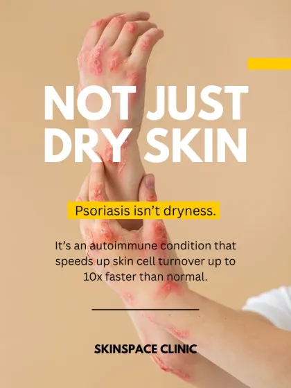 Psoriasis is fundamentally different from dry skin. It is an internal autoimmune process where skin cell turnover is up to 10 times faster than normal, requiring a medical approach to treatment.