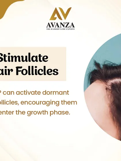 This is a close-up of our Platelet-Rich Plasma (PRP) therapy in action. The procedure uses concentrated growth factors from your own blood, which are carefully injected into the scalp to activate dormant hair follicles and encourage them to enter the growth phase.