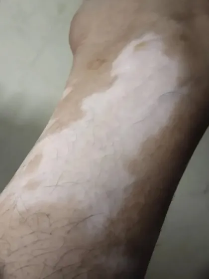 This is a case of Leucoderma Vitiligo vulgaris on the lower leg. I have a solution for such conditions, having cured over 5000 patients with a systematic approach.