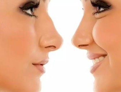 Rhinoplasty is a transformative procedure. Here, you can see how it can refine the nose's shape, bringing it into better balance with the rest of the face for an improved aesthetic.