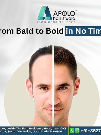 This image captures our promise: to take you from bald to bold in no time. Our skin-friendly, non-surgical solutions can cover a bald area in just an hour.
