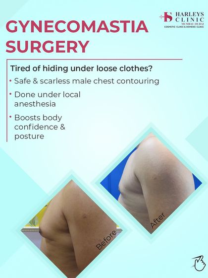 If you find yourself hiding under loose clothes, know that a solution exists. This graphic shows a side-profile before and after of a gynecomastia correction, emphasizing that the procedure is safe, can be done under local anesthesia, and greatly improves posture and confidence.