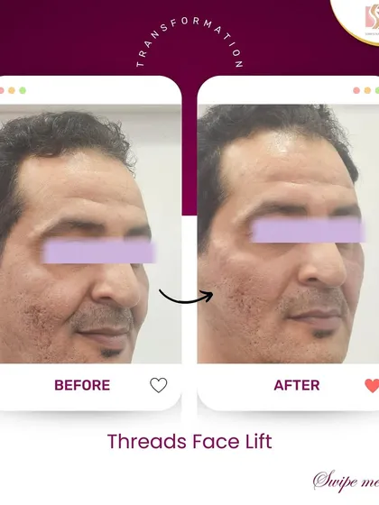 This is a perfect example of what a thread facelift can achieve. You can see a clear, yet natural-looking lift and improved contour in the 'after' photo. We achieved this without surgery by using dissolvable threads to lift sagging skin and stimulate collagen.
