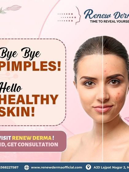 A before-and-after visual showing the journey from pimples to healthy skin. If you're struggling with acne, our customized acne buster treatments can provide the solution you've been looking for.