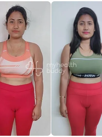 Sangita's front view comparison. She achieved her goals without feeling like she was on a restrictive diet, proving that a balanced approach is key.