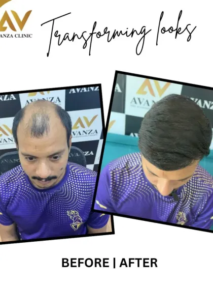 A great example of how a hair transplant can turn back the clock. We restored this client's hairline and filled in the mid-scalp, giving him a much younger and fuller look.