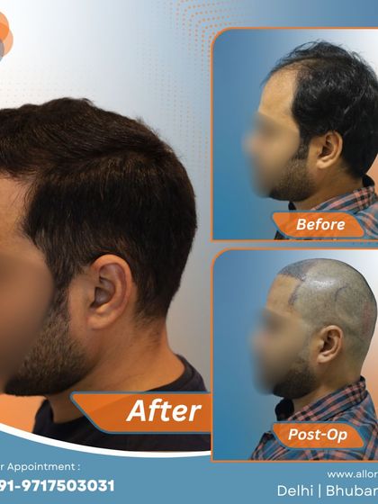 This series shows the complete process for a patient, from the before and post-op stages to the final impressive result. It gives a comprehensive view of the transformation journey.