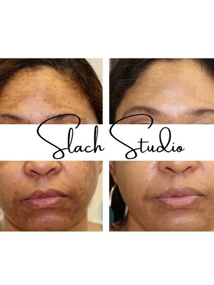 This collage shows the successful lightening of widespread pigmentation, restoring a uniform and radiant complexion.