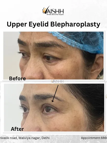 A side profile view showing the results of an upper eyelid surgery. The lift is natural and enhances the patient's features without looking overdone.