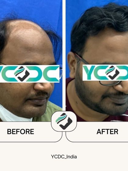 This patient's result after six months demonstrates a remarkable change in hair density and hairline definition. The FUE technique allows for such natural and impressive outcomes.
