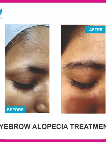 Hair loss isn't limited to the scalp. Here is a successful eyebrow alopecia treatment, where we restored fullness and definition to the client's brows.