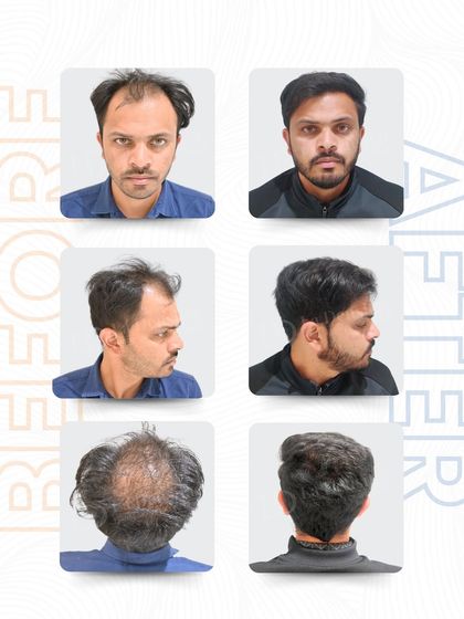 Here is Uddhav's complete transformation from all angles. The 3,500 grafts were used to restore his hairline and add density to the crown, resulting in a full and natural head of hair that he can be proud of.