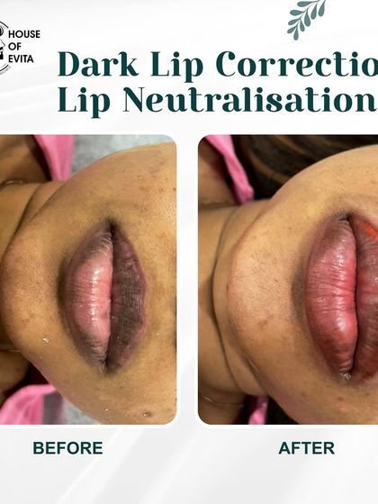 Another view of the Lip Neutralization process. The goal is to first cancel out the cool, dark tones before we can add the target color in a second session.