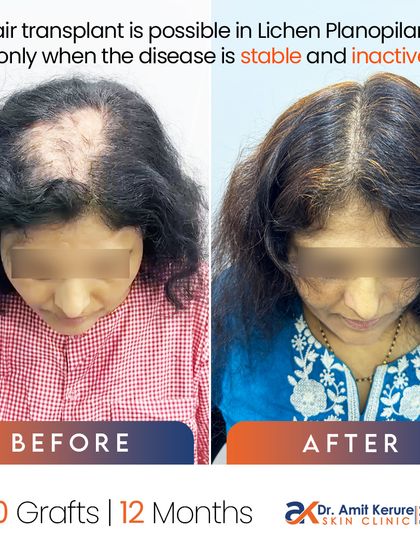 This side-by-side comparison clearly shows that a hair transplant is possible in Lichen Planopilaris, but only when the disease is stable and inactive. This is a critical factor for success.