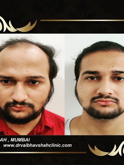 This patient had a large area of baldness on the front and top. The result is a full head of hair that looks completely natural.