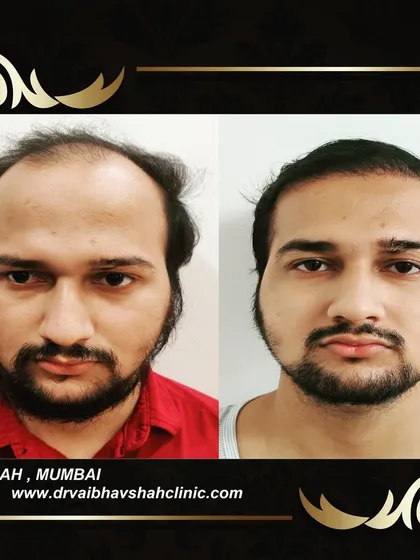 This patient had a large area of baldness on the front and top. The result is a full head of hair that looks completely natural.