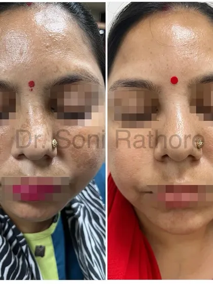 A clear example of successful melasma treatment. Through a consistent, multi-step plan including prescription creams, chemical peels, and laser treatments, we achieved a dramatic reduction in hyperpigmentation and a much more even skin tone.