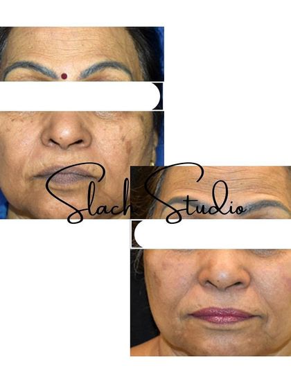 This before-and-after collage shows a significant reduction in pigmentation and a more even, glowing skin tone.
