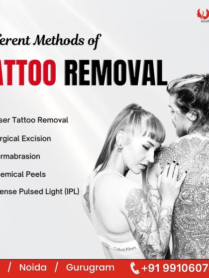 While there are several methods for tattoo removal, we specialize in the most advanced options. We primarily use Laser Tattoo Removal for its safety and effectiveness, but we can discuss other options like Chemical Peels during your consultation.