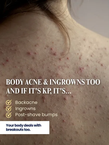 Keratosis Pilaris is often associated with other concerns like body acne, ingrown hairs, and post-shave bumps. Understanding the connection helps in creating a comprehensive treatment plan for smoother skin.