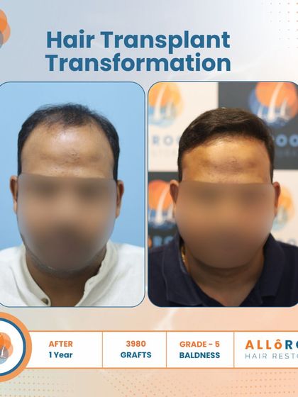 A one-year transformation for a Grade 5 baldness case using 3980 grafts. The images show the before, the immediate post-op, and the final result, demonstrating the entire process and its successful outcome.