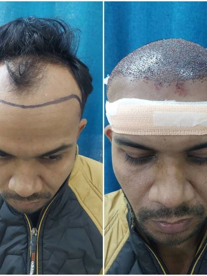 A direct comparison of a patient before the procedure with the hairline marked, and immediately after the FUE grafts have been implanted.