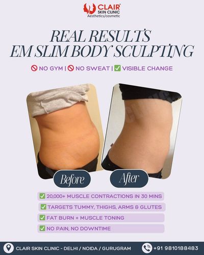 Non-Surgical Body Contouring