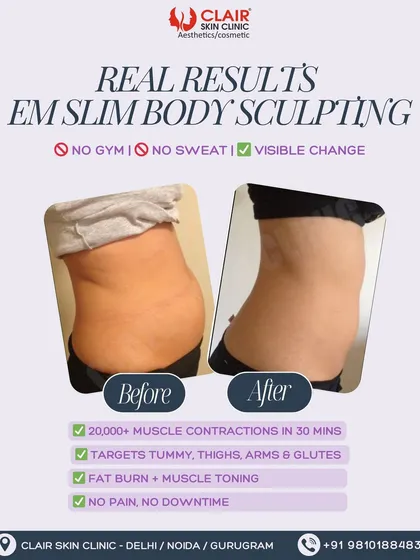 (Hero Media) See the real, visible change for yourself. This client achieved significant fat reduction and a more toned waistline with our EM Slim body sculpting treatment. This is the power of stimulating over 20,000 muscle contractions in just 30 minutes, with absolutely no downtime.