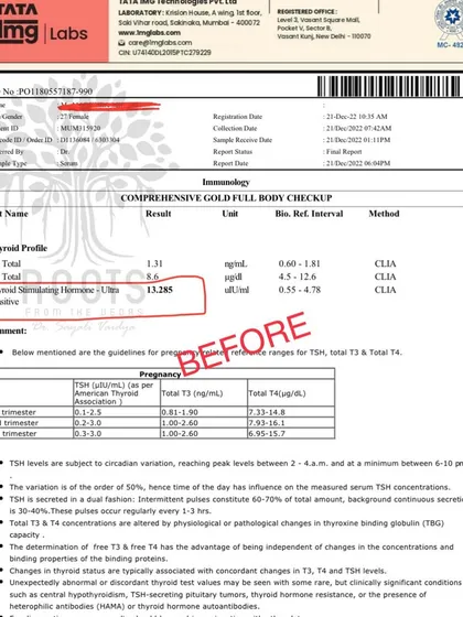 Here is a "before" report showing a patient's Thyroid Stimulating Hormone (TSH) level at 13.285, which is significantly elevated and indicates hypothyroidism.