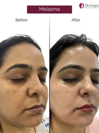 Another angle of a successful melasma treatment, this image shows the 'before' state with deep pigmentation and the 'after' state with visibly clearer and brighter skin.