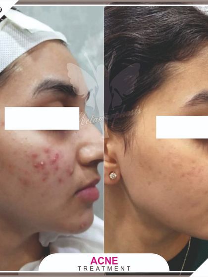 The side view of this client's acne treatment shows how our methods effectively clear up breakouts on the cheeks and jawline.