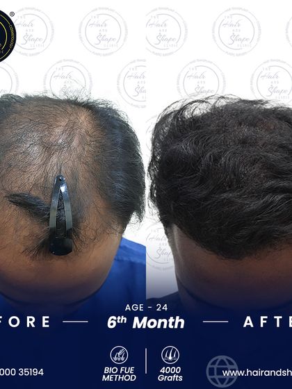 The top-down view at 6 months shows how we filled in the thinning crown and mid-scalp area for a complete restoration.