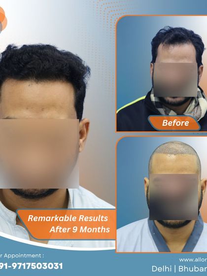 Remarkable results after just 9 months. This series shows the before, post-op, and after stages, highlighting the efficiency and effectiveness of the procedure.