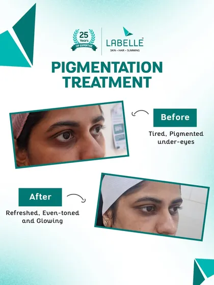 This before and after photo shows the power of our pigmentation treatment. We effectively targeted pigmented under-eyes, resulting in a refreshed, even-toned, and glowing appearance for our client.