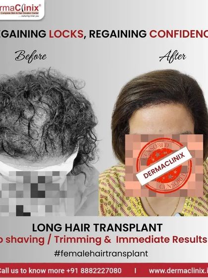 Regaining locks, regaining confidence. This before and after of a female Long Hair Transplant shows the immediate results and the benefit of no shaving or trimming.