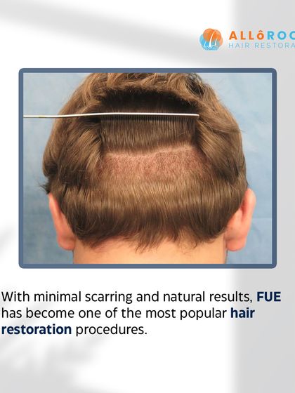This series explains the Follicular Unit Extraction (FUE) technique. It is a minimally invasive method where I extract individual hair follicles and transplant them, resulting in minimal scarring and natural-looking, permanent hair.