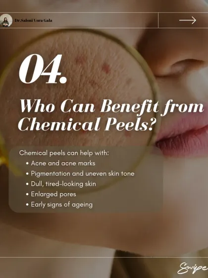 Who can benefit from a chemical peel? This treatment is highly effective for a range of concerns, including active acne, acne marks, pigmentation, uneven skin tone, dullness, enlarged pores, and even early signs of aging.