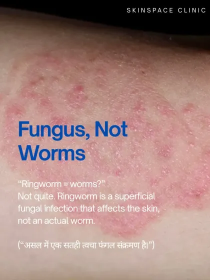 Despite its name, "ringworm" has nothing to do with worms. It is a superficial fungal infection of the skin. Correctly identifying it as a fungus is the first step to the right treatment.
